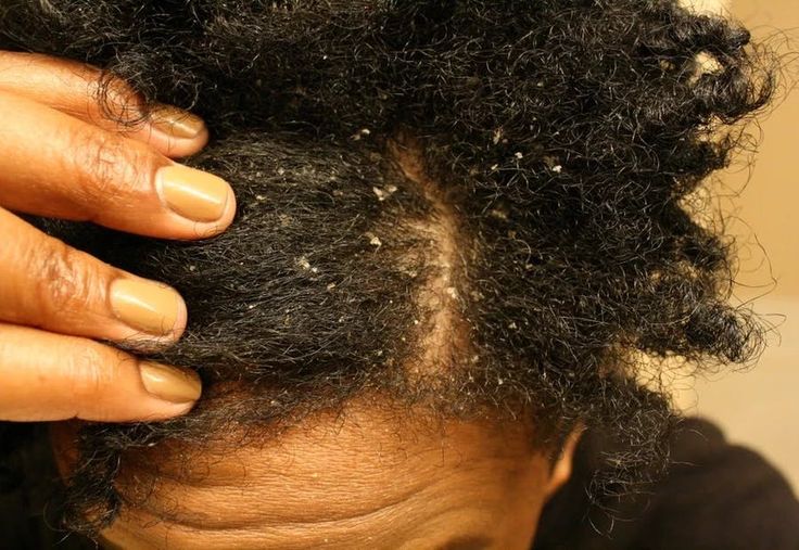 Dandruff: Myths, Facts & The Truth Your Scalp Wants You to Know