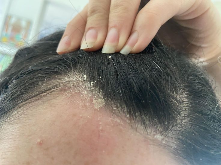 Dandruff vs. Dry Scalp: What’s Really Going On Up There?
